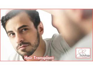Get Hair Transplant in Gurgaon At SB Trichology