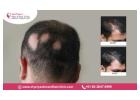 Get the Best Alopecia Treatment in Bangalore for Healthy Hair - Dr. Priya Skin and Hair Clinic