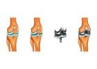 Expert Knee Replacement Surgeon in Ahmedabad
