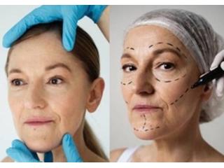 Find Best Option for Face Lift in Adelaide for Long Lasting Results