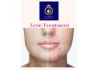 Top-Rated & Best Acne Treatment in Thane – Visit DNA Royal Today.