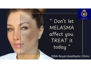 Best Melasma Treatment in Thane by DNA Royal Skin Experts.