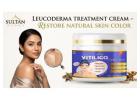 Leucoderma Treatment Cream – Restore Natural Skin Color