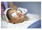 Advanced Acne Scar Treatment in Dubai for Clear & Healthy Skin