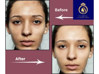 Affordable Chemical Face Peel in Thane | DNA Royal Experts.