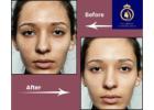 Affordable Chemical Face Peel in Thane | DNA Royal Experts.