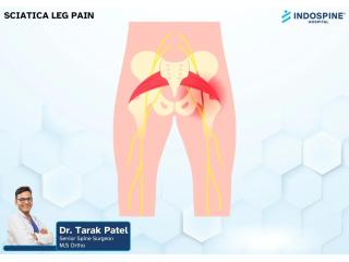 Sciatica (Leg Pain) Treatment Specialist in Ahmedabad | Best Spine Surgeon in Ahmedabad