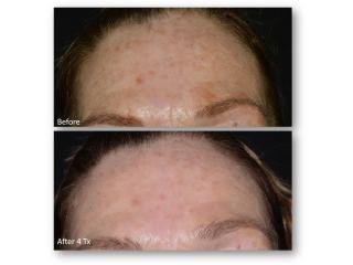 Advanced Hyperpigmentation Treatment Tampa