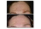 Advanced Hyperpigmentation Treatment Tampa