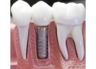 How Do You Know If a Root Canal Has Failed and What Are the Next Treatment Options?