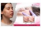Get Flawless Skin with the Best Acne Scars Treatment in Bangalore - Dr. Priya Skin and Hair Clinic