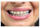 Removable Teeth Braces in Dombivli – Comfortable Care