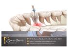 Top-Rated Root Canal Treatment in Menifee – Gentle Dentistry