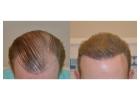 Hair Transplant Cost in Delhi Explained – Save on Treatment