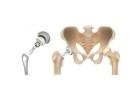 Expert Hip Replacement Treatment in Ahmedabad