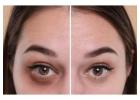 Advanced Dark Circle Treatment in Dubai for Brighter, Youthful Eyes