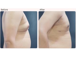 Gynecomastia Surgery in Delhi - Dr Rajat Gupta