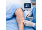 Varicose veins surgery in Baner - The Aesthetic Hub