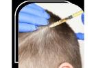 Natural Hair Transplant Results in Mumbai