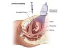 Budget Amniocentesis test | Fetal India