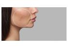 Clear Your Skin with Expert Acne Care at Kara Skin Clinic