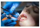 Expert Tooth Extraction in Beverly Hills | Safe & Gentle Care