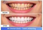 Professional Teeth Whitening in Mumbai Andheri | AK Dental Clinic