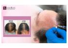 Get Natural Hair Growth with GFC Treatment in Bangalore - Dermaqure