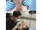 Advanced Hair Transplant In Kondapur For Receding Hairlines