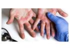 Atopic Dermatitis Treatments in Gurgaon | Expert Care