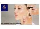 DNA Royal: Best Melasma Treatment in Thane for Clear, Even Skin.