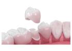 Dental Crowns in San Antonio, TX