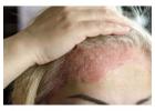 Eczema Rash Treatment in Gurgaon | Skin Experts