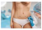 Affordable Liposuction in South Africa with Expert Care