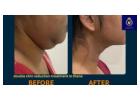 Affordable Double Chin Reduction Treatment in Thane | DNA Royal.