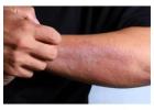 Best Dermatologist for Eczema Treatment Gurgaon