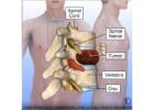 Lumbar Disc Herniation Treatment | Best Spine Surgeon in Ahmedabad