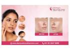 Achieve Spotless Skin with Acne Scar Treatment in Bangalore - Dr. Priya Skin and Hair Clinic