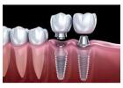 Reliable Dental Implants in Encino for Stronger, Healthier Smiles