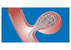 Advanced Coil Embolisation for Aneurysm Care | IR Facilities