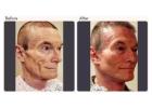 Facelift Surgery Cost In Delhi NCR - Dr Rajat Gupta