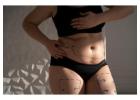Tummy tuck in South Africa for a Flatter and Toned Abdomen