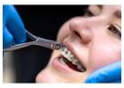 Dental Braces in Tambaram | Dr.Amarnathan Dental Care