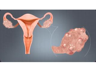Best PCOS doctor in Dubai – Women Health