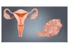 Best PCOS doctor in Dubai – Women Health