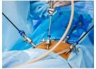 Laparoscopy for Infertility in Delhi - Dr Rhythm Gupta