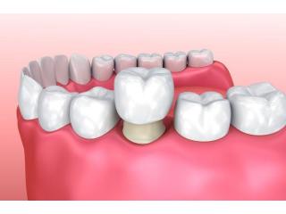 Cosmetic Dental Crowns & Veneers in Perris - Dr. Tejas Modi