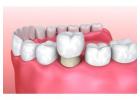 Cosmetic Dental Crowns & Veneers in Perris - Dr. Tejas Modi