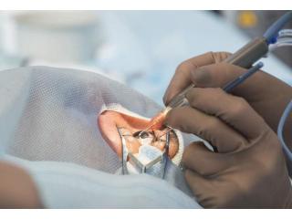 Can I Live With Cataracts Without Surgery?