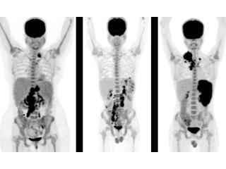 Accurate PET Scan in Mumbai for Cancer Detection – Picture This